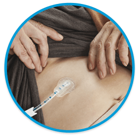 sonda_gastrostomia_circulo